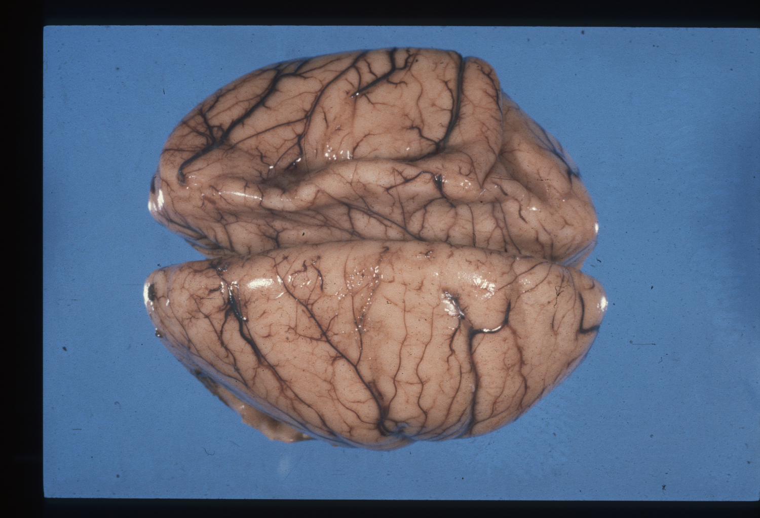 Cerebro afectado por hidrocefalia posthemorrágica